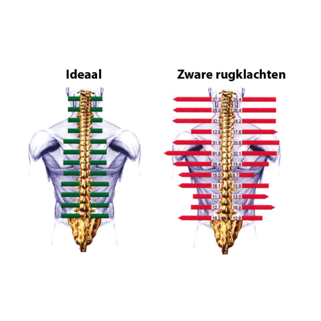 Ideaal versus zware rugklachten